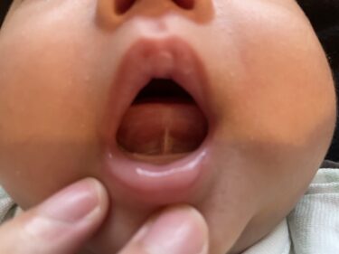 失敗が怖い！？息子に舌小帯・上唇小帯の手術を決めた6つの理由（生後２カ月）